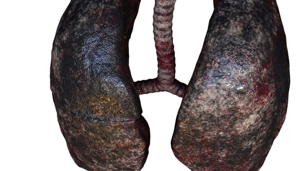 Respiratory organs darkened from resins with 3d render unhealthy spots. Anatomical trachea affected by cancer with diseased pleura leaking viruses. Bad habit symbol with realistic design.