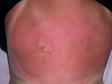 Man with a severe burn on his back. Close up.