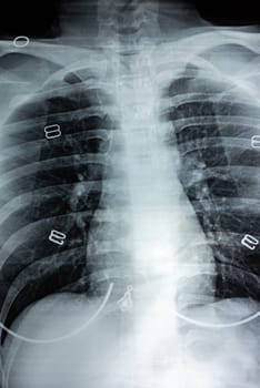 Film X-ray of breast a person, Film grain style