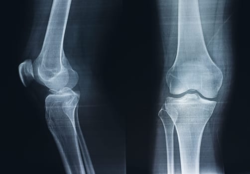 Film X-ray of a leg bone person, Film grain style