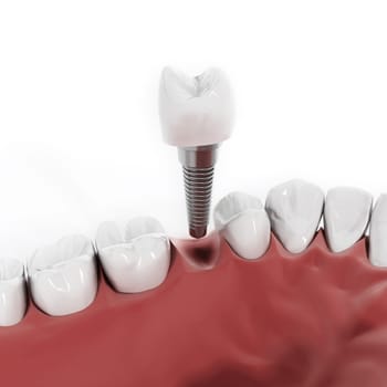 Illustration of teeth showing dental implant structure