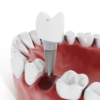Illustration of teeth showing dental implant structure