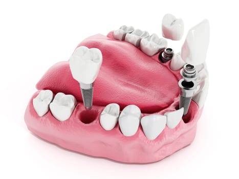 Illustration of teeth showing dental implant structure