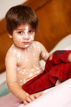 Chickenpox