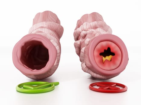 Obstructed and unobstructed bronchial tubes representing asthma. 3D illustration.
