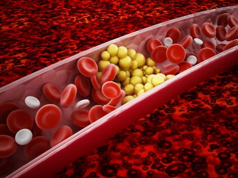 Fat cells blocking the blood flow inside human vein. 3D illustration.