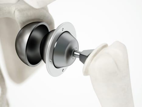3D illustration of shoulder replacement surgery. 3D illustration.