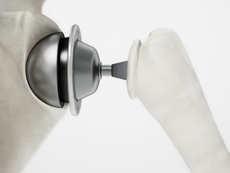 3D illustration of shoulder replacement surgery. 3D illustration.