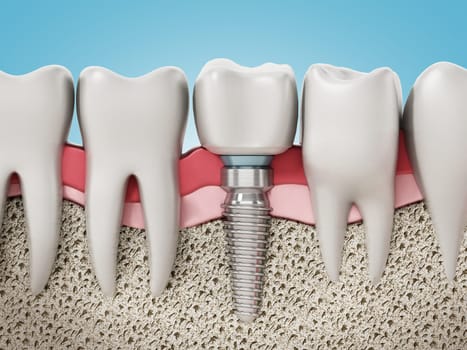 3D rendering of tooth implant showing jaw gum and bone layers. 3D illustration.