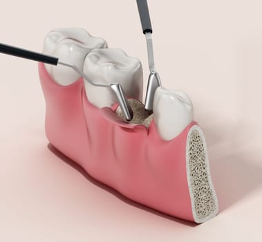 3D illustration of mid-crestal incision dental operation. 3D illustration.