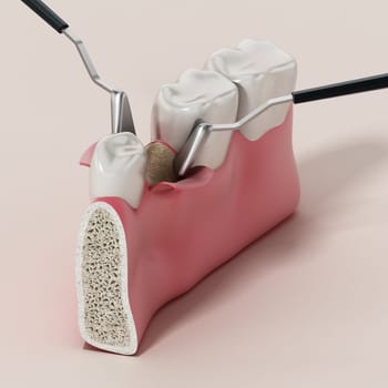 3D illustration of mid-crestal incision dental operation. 3D illustration.