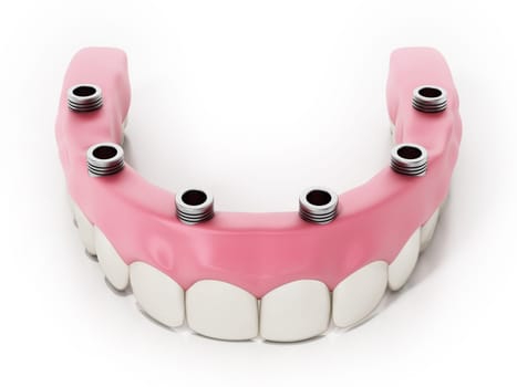 Dental prosthesis isolated on white background. 3D illustration.