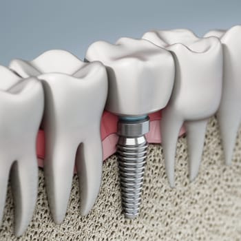 3D rendering of tooth implant showing jaw gum and bone layers. 3D illustration.
