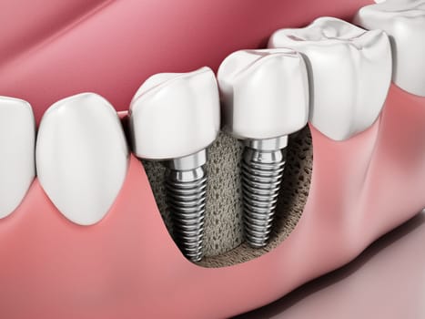 3D illustration of two dental implants on the lower jaw.