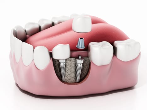 3D illustration of two dental implants on the lower jaw.