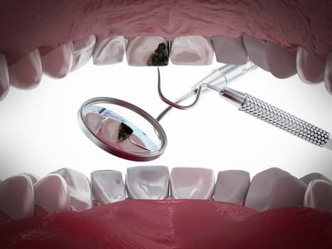 Decayed tooth diagnosis and treatment. 3D illustration.
