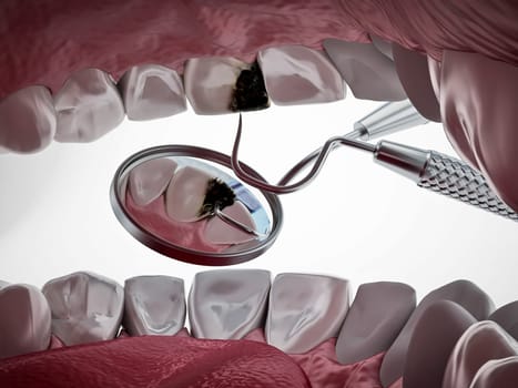 Decayed tooth diagnosis and treatment. 3D illustration.