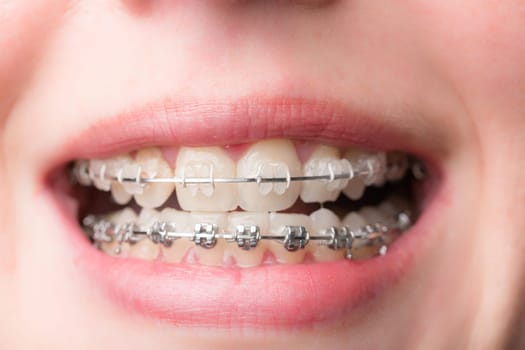 close-up of a female teenager's mouth with a dental brace