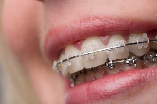 close-up of a female teenager's mouth with a dental brace