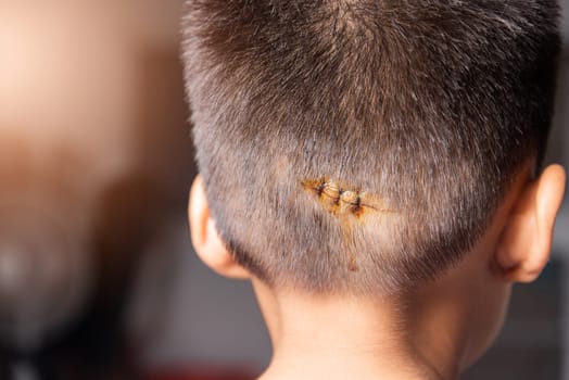 The lacerated sutured wound of kid back head which suture by nylon suture about 3 stitches at the emergency room of the hospital, Medical care of the surgery lesion on the head, children of Accident