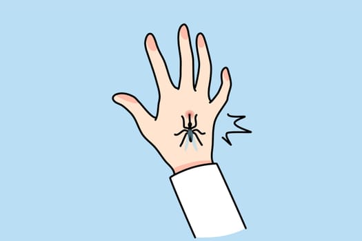 Close up of mosquito bite hand. Bug or insect biting person leave spot or mark. Healthcare and nature. Vector illustration.