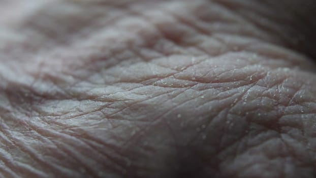 Close Up Of Senior's Hands With Alzheimer Disease