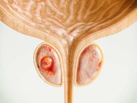 Prostate Cancer Stage 01 of 04 -- Detailed High Quality 3D Rendering