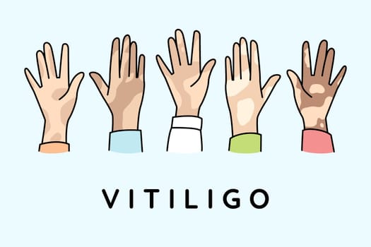 Diverse hands of people suffer from vitiligo disease. People struggle with pigmentation on body. World vitiligo day concept. Vector illustration.
