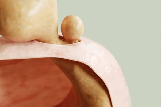Mixed form of hiatus hernia type 3 - entrance to the stomach and protrusion of the stomach through the diaphragm -- 3D rendering