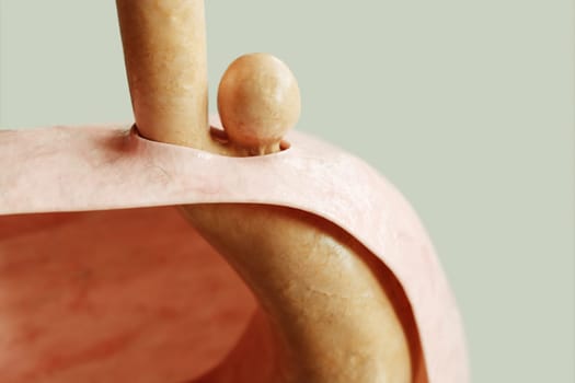 Paraesophageal Hiatus Hernia Type 2 - Stomach protrusion through diaphragm, gastric entrance in normal condition -- 3D rendering