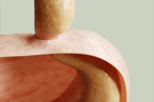 Axial hiatus hernia type 1 - entrance to the stomach via the diaphragm -- 3D rendering