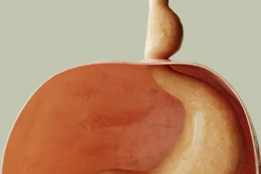 Axial hiatus hernia type 1 - entrance to the stomach via the diaphragm -- 3D rendering