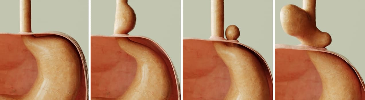 Hiatus hernia - Healthy and 3 types of diaphragmatic hernia -- 3D rendering