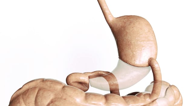Stomach reduction 3 of 4- Biliopancreativ Diversion BPD -- 3D Rendering