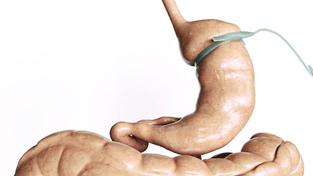 Stomach reduction 3 of 4- - Adjustable Gastric Band - AGB -- 3D Rendering
