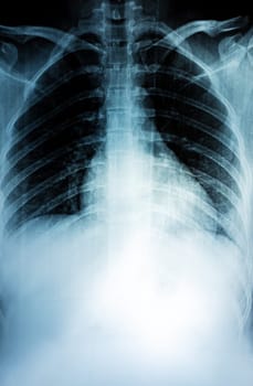 Film X-ray of breast a person, Film grain style