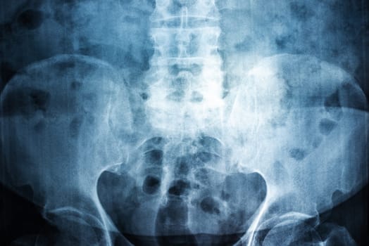 Film X-ray of spine a person, Film grain style