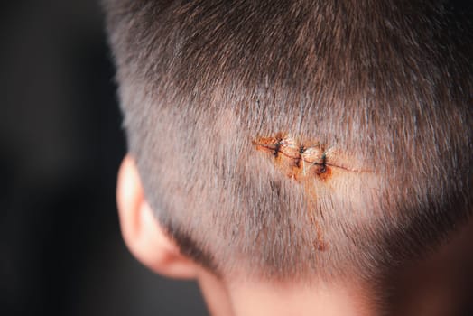 The lacerated sutured wound of kid back head which suture by nylon suture about 3 stitches at the emergency room of the hospital, Medical care of the surgery lesion on the head, children of Accident
