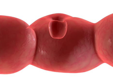 3d rendered illustration ofa human colon with cancer