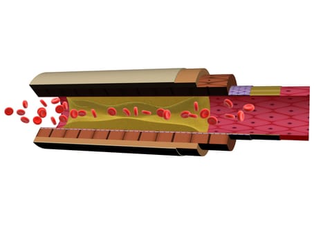 3d rendered illustration from a section of an artery with a blockage