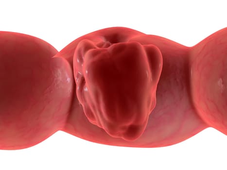 3d rendered illustration ofa human colon with cancer