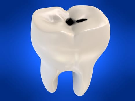 3d rendered illustration of a human tooth with caries