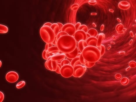 3d rendered illustration of an artery with a blood clot