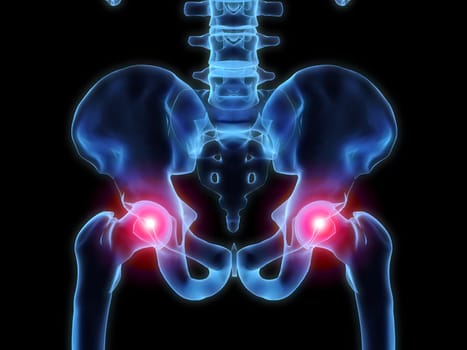 3d rendered anatomy illustration of human hips with pain