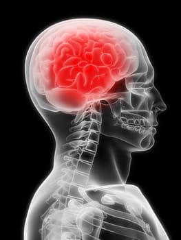 3d rendered x-ray illustration with a painful brain