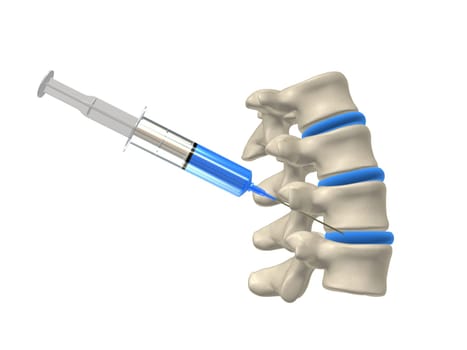 3d rendered anatomy illustration from a part of a spine with an injection