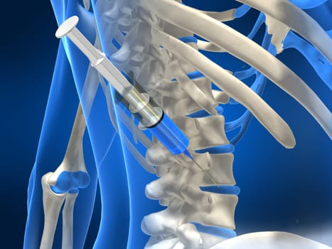 3d rendered anatomy illustration of a human back with an injection