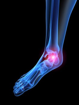 3d rendered x-ray illustration of a human painful foot