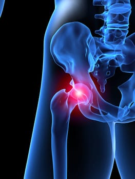 3d rendered x-ray illustration of a painful hip