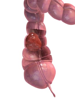 3d rendered anatomy illustration of a colon with a cancer